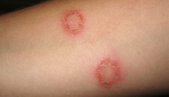 Prevent Fungal Infection